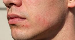 treat razor burn quickly