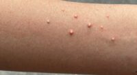 bumpy skin on arms
