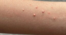bumpy skin on arms